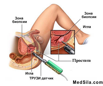 УЗИ простаты