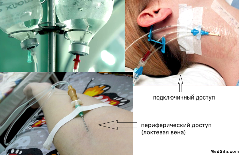 Доступы к венам